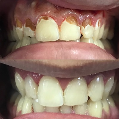 Anterior Veneering - results-dranujagundechakatariya-bizknow.in-7