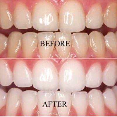 Teeth Whitening - results-dranujagundechakatariya-bizknow.in-4