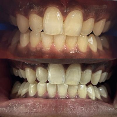 Teeth Whitening - results-dranujagundechakatariya-bizknow.in-5